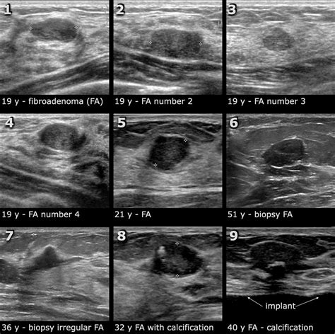 <b>Ultrasounds</b> use soundwaves to produce images of. . Why would a lump not show up on ultrasound